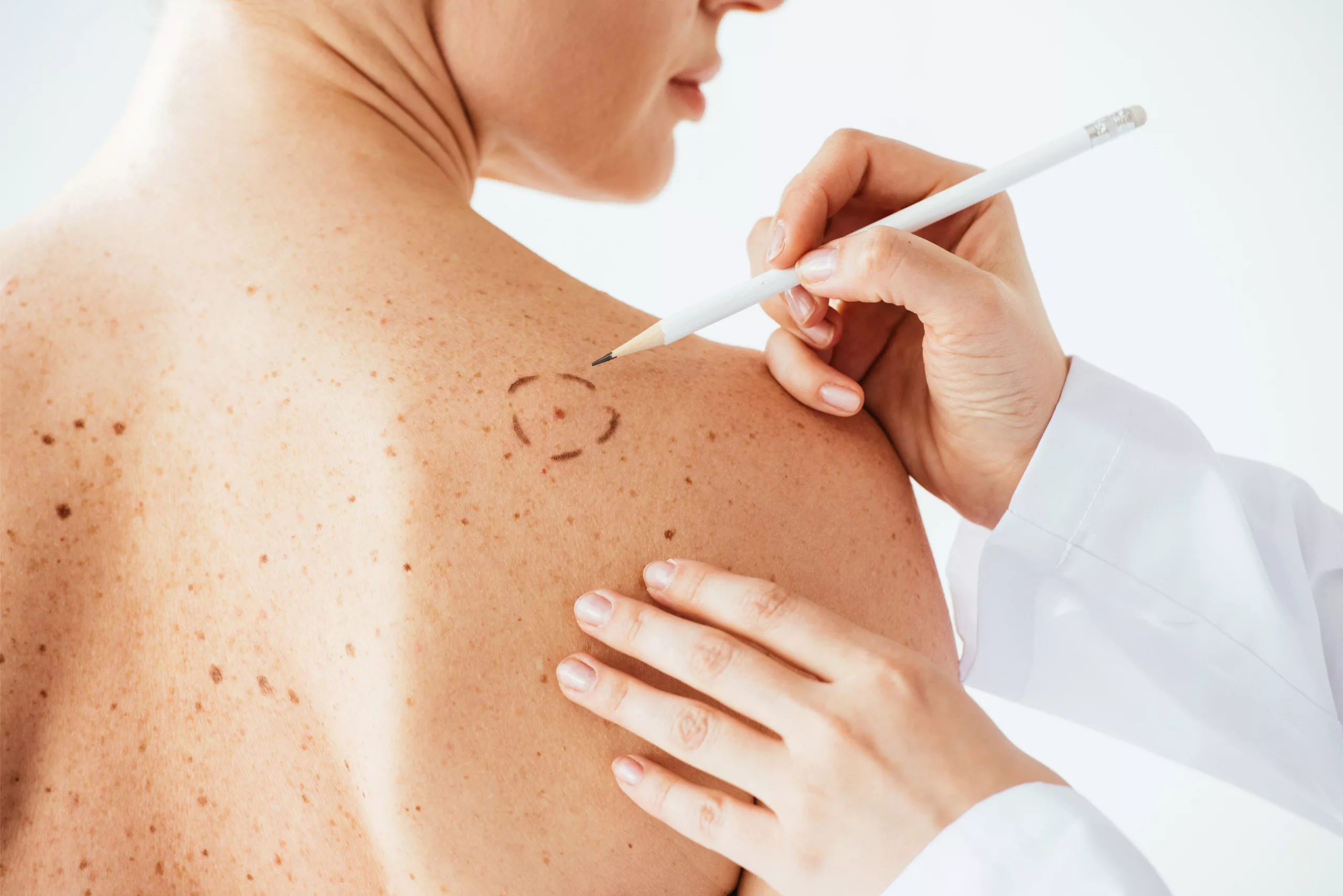 Dermatologie chirurgicale grains de beauté Casablanca